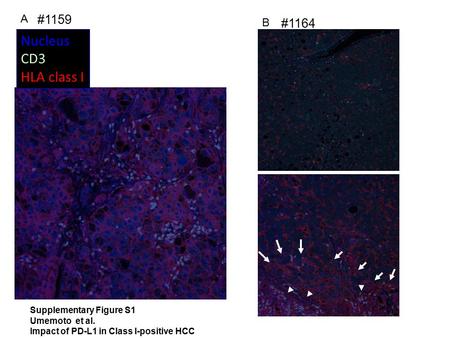 #1159 #1164 Nucleus CD3 HLA class I A B Supplementary Figure S1 Umemoto et al. Impact of PD-L1 in Class I-positive HCC.