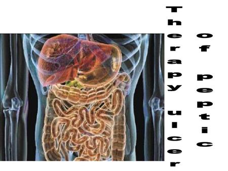 Peptic ulcer defects of mucosa of the stomach / duodenum = mucosal damage through the lamina muscularis mucosae Clinical presentation: stomach – pain.