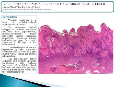 Introduction Verrucous carcinoma is a form of well-differentiated squamous cell carcinoma. The recognized clinical subtypes of verrucous carcinoma are: