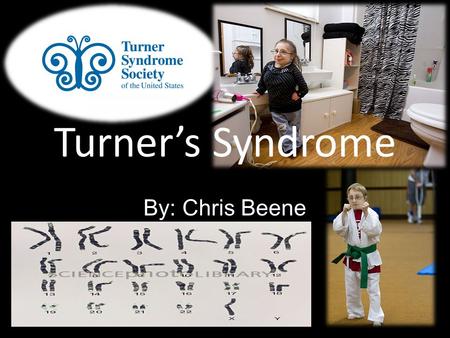 Turner’s Syndrome By: Chris Beene. What is it, Henry Turner? A chromosomal disorder that alters growth and development in females. Women with turner’s.