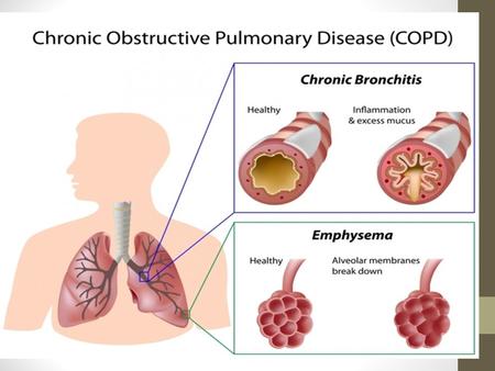 Chronic Obstructive Pulmonary Disease ystic Fibrosis ronchitis – Chronic sthma ronchiectasis mphysema.