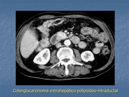 Colangiocarcinoma extrahepático polipoideo-intraductal.