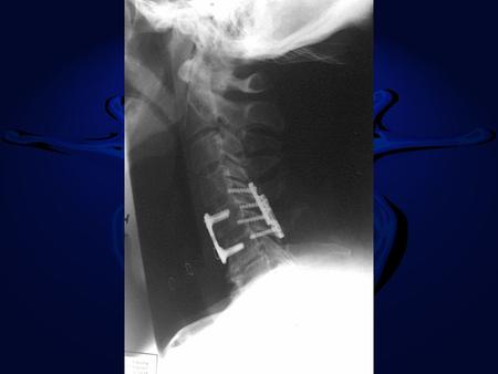 Respiratory disease main cause of death in Spinal Cord Injury.