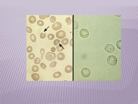 Kunwardeep Sohal, R3  2 ways to destroy RBC: issues within the RBC and/or its membrane (intracorpuscular defects) vs extracorpuscular  Examples of.