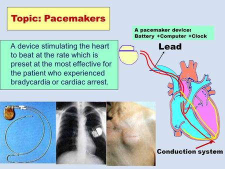 Topic: Pacemakers A device stimulating the heart to beat at the rate which is preset at the most effective for the patient who experienced bradycardia.