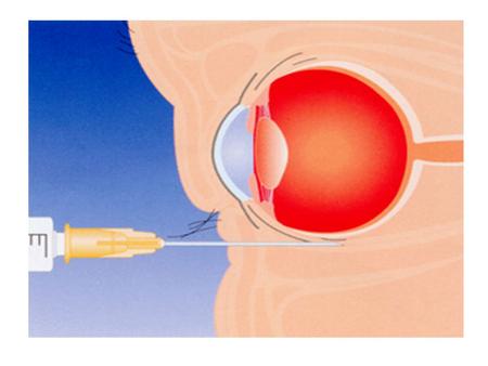 REGIONAL ANAESTHESIA IN OPTHALMIC SURGERY