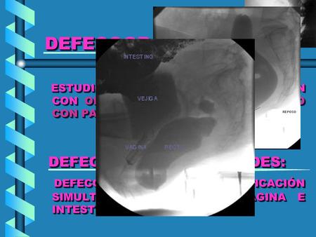 DEFECOGRAFÍA: DEFECOGRAFÍA: ESTUDIO DINÁMICO DE LA DEFECACIÓN CON OPACIFICACIÓN PREVIA DEL RECTO CON PASTA DE BARIO. ESTUDIO DINÁMICO DE LA DEFECACIÓN.