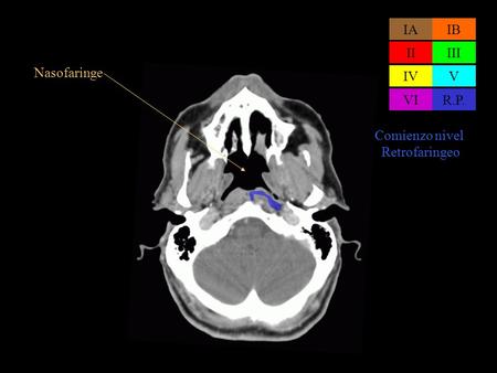 Nasofaringe IAIB IIIII IVV VIR.P. Comienzo nivel Retrofaringeo.