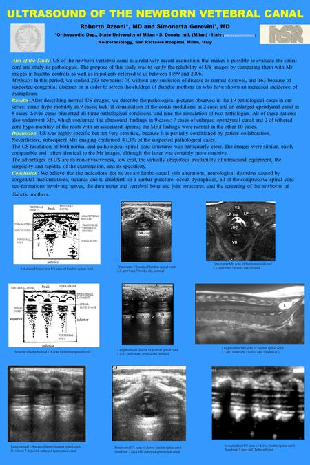 ULTRASOUND OF THE NEWBORN VETEBRAL CANAL Roberto Azzoni*, MD and Simonetta Gerevini°, MD *Orthopaedic Dep., State University of Milan - S. Donato mil.