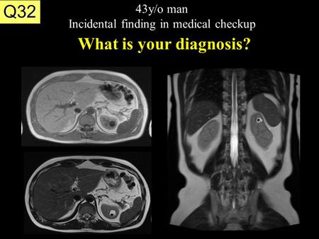 43y/o man Incidental finding in medical checkup What is your diagnosis? Q32.