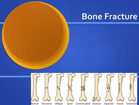 Bone Fracture. Recall: Three types of Stress: Three types of Stress: Tension Tension Compression Compression Shear Shear.