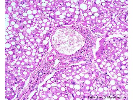 Fatty Liver; D. Marzo lecture. Robbins & Cotran Pathologic Basis of Disease, 2005.