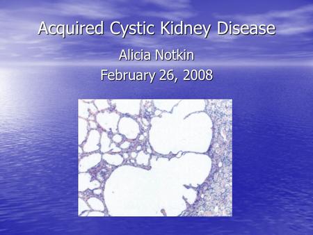 Acquired Cystic Kidney Disease Alicia Notkin February 26, 2008.