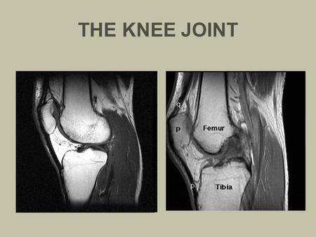 THE KNEE JOINT. BONES OF THE KNEE FEMUR Lateral condyle (6 left) Medial condyle (8 left) Intercondylar fossa (7 left)