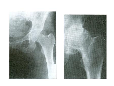 ARTHROSCOPIC FEATURES Chondromalacia Advanced chondromalacia Cartilage eburnation.