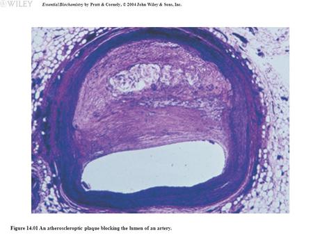 Essential Biochemistry by Pratt & Cornely, © 2004 John Wiley & Sons, Inc. Figure 14.01 An atheroscleroptic plaque blocking the lumen of an artery.