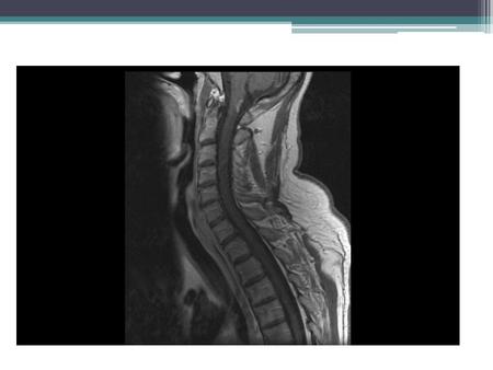 Transverse Myelitis Emily O. Jenkins MD, PGY3 AM Report 12.18.09.