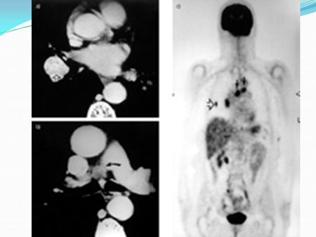 Metastatic involvement (M) M0 - No metastases M1 - Metastases present.