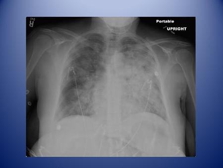 Peripartum Cardiomyopathy Paul M. Johnson Department of Internal Medicine University of North Carolina Hospitals November 11, 2009.