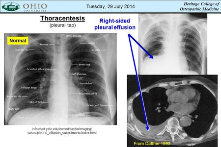 Heritage College of Osteopathic Medicine Thoracentesis (pleural tap) info.med.yale.edu/intmed/cardio/imaging/ cases/pleural_effusion_subpulmonic/index.html.