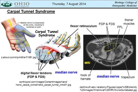 Heritage College of Osteopathic Medicine Carpal Tunnel Syndrome z.about.com/d/p/440/e/f/1081.jpg eorthopod.com/images/ContentImages/hand/ hand_carpal_tunnel/hand_carpal_tunnel_intro01.jpg.