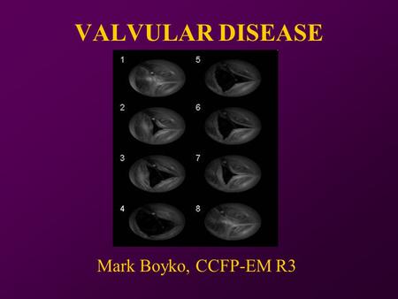 VALVULAR DISEASE Mark Boyko, CCFP-EM R3. One night at the Foot… 64yo male found down at home… -HR 111 -BP 109/67 -RR 12 -Temp 38.6 -O2 88% -Glucose 22.