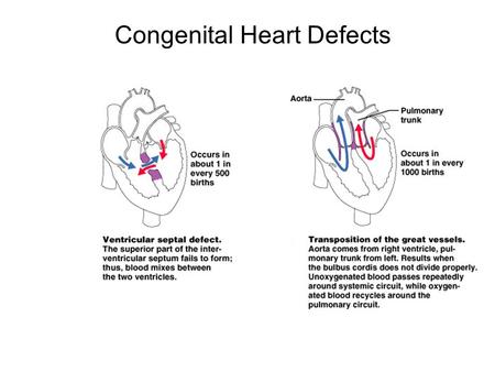 Congenital Heart Defects