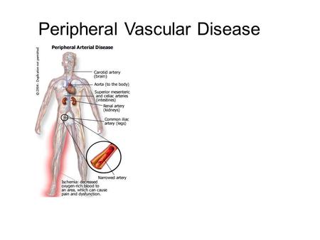 Peripheral Vascular Disease