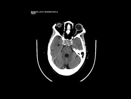 Pituitary Apoplexy Kyla Lokitz Morning Report 7/18/05.