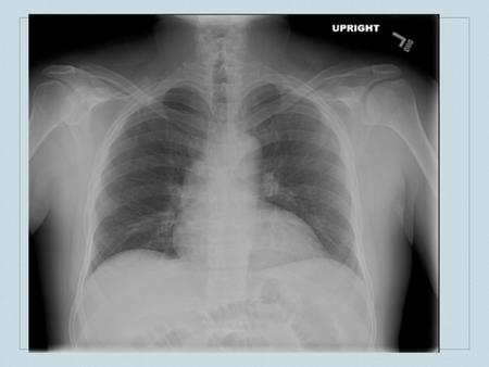 Strongyloides stercoralis in transplant patients Alisa Alker.