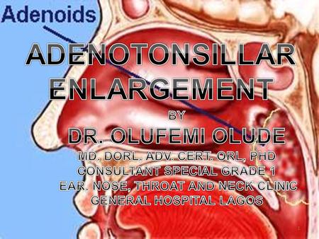 ADENOTONSILLAR ENLARGEMENT