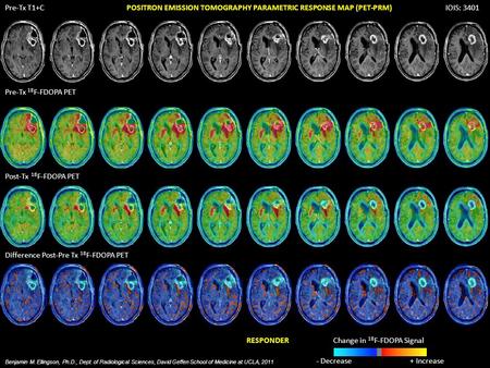 Pre-Tx 18 F-FDOPA PET Pre-Tx T1+C Post-Tx 18 F-FDOPA PET Difference Post-Pre Tx 18 F-FDOPA PET IOIS: 3401 Benjamin M. Ellingson, Ph.D., Dept. of Radiological.