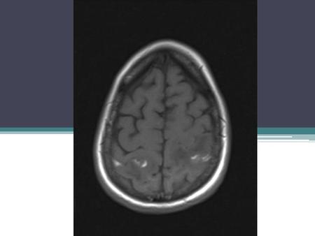 Cerebral Vein Thrombosis Morning Report Sima Patel 5/13/09.