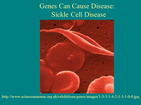 Genes Can Cause Disease: Sickle Cell Disease