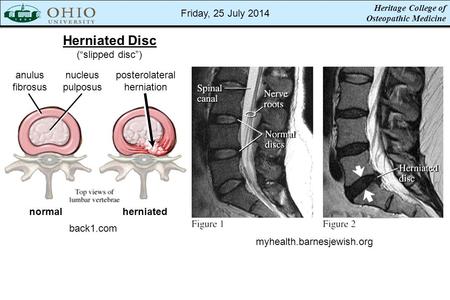 Heritage College of Osteopathic Medicine Herniated Disc (“slipped disc”) back1.com myhealth.barnesjewish.org normalherniated anulus fibrosus nucleus pulposus.