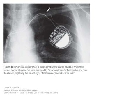 Trappe, H; Gummert, J Current Pacemaker and Defibrillator Therapy Dtsch Arztebl Int 2011; 108(21): 372-80; DOI: 10.3238/arztebl.2011.0372.