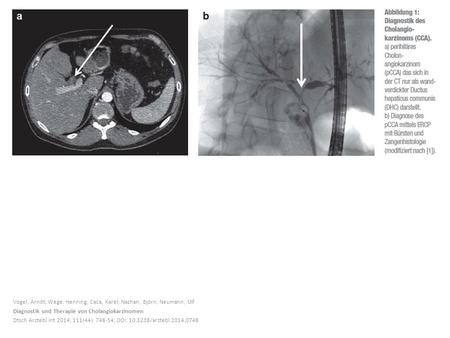 Vogel, Arndt; Wege, Henning; Caca, Karel; Nashan, Björn; Neumann, Ulf Diagnostik und Therapie von Cholangiokarzinomen Dtsch Arztebl Int 2014; 111(44):