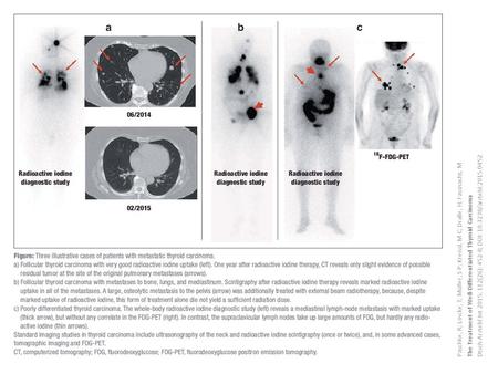 Paschke, R; Lincke, T; Müller, S P; Kreissl, M C; Dralle, H; Fassnacht, M The Treatment of Well-Differentiated Thyroid Carcinoma Dtsch Arztebl Int 2015;