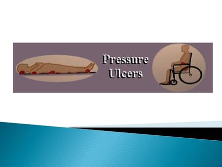 Pressure Ulcers Definition