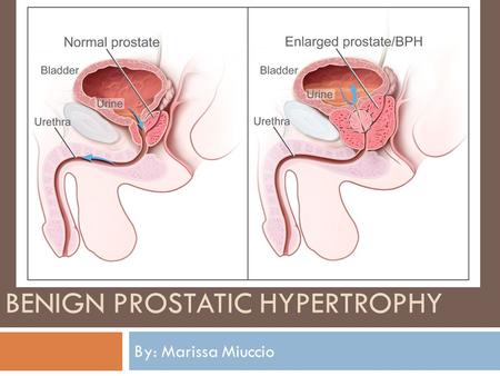 Benign Prostatic Hypertrophy