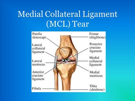 Medial Collateral Ligament (MCL) Tear