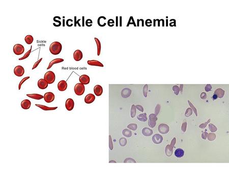 Sickle Cell Anemia.