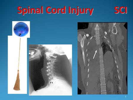 Spinal Cord Injury SCI.