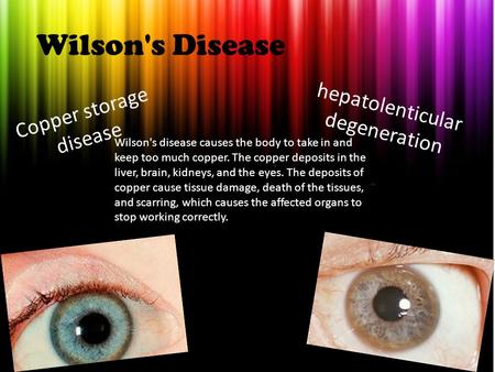 Wilson's Disease hepatolenticular degeneration Copper storage disease Wilson's disease causes the body to take in and keep too much copper. The copper.