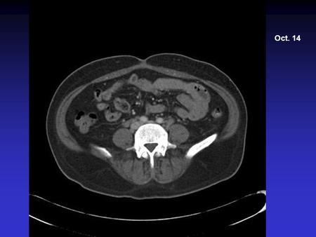 Oct. 14 There is no evidence of bowel obstruction or dilatation. 1. Extensive axillary, mediastinal, abdominal, pelvic lymphadenopathy, as above, most.