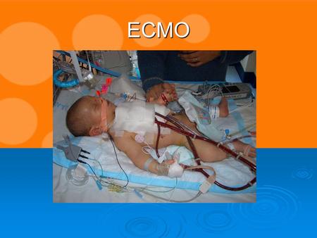 ECMO.