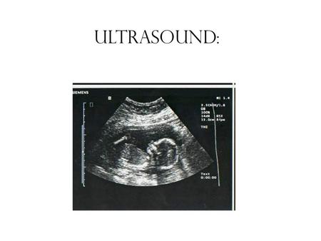 Ultrasound:. Machine Using sound waves to look at physical features of the developing fetus including size, anatomy, number of appendages/parts, sex,