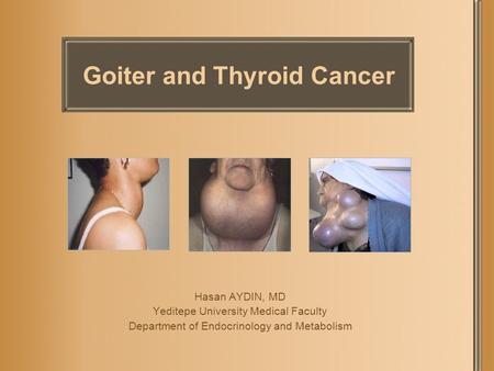 Goiter and Thyroid Cancer