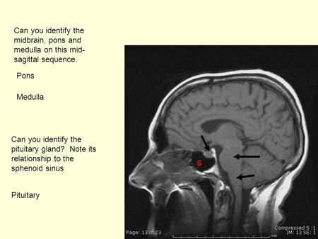 Can you identify the pituitary gland