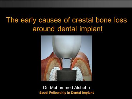 Dr. Mohammed Alshehri Saudi Fellowship in Dental Implant The early causes of crestal bone loss around dental implant.